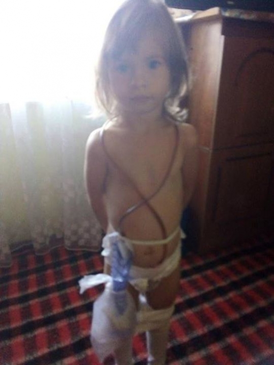 4-річна Вероніка зі Сторожинеччини має вроджену аномалію нирок і потребує допомоги