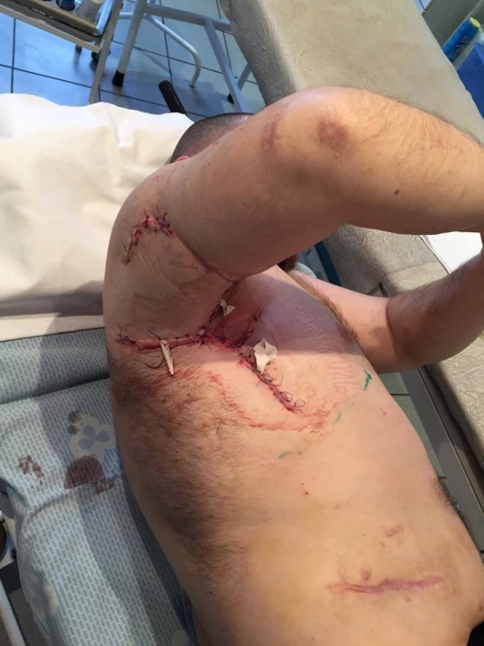 Чернівчанин отримав важке поранення в зоні АТО - йому потрібні кошти на лікування