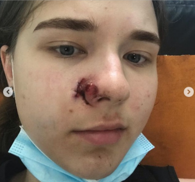 У готелі на Прикарпатті киянин вистрілив у обличчя дівчини