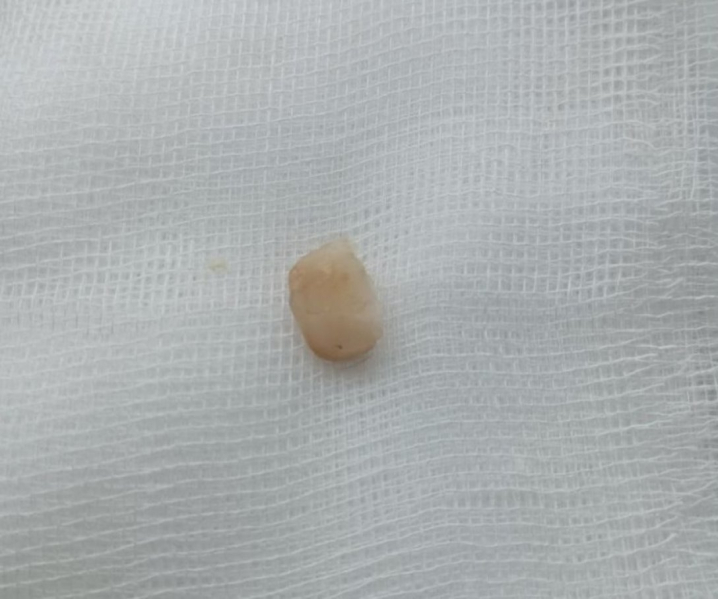 Львів'янка 8 місяців не могла позбутися кашлю: у жінки в легенях застряг зуб Львів'янка 8 місяців не могла позбутися кашлю: у жінки в легенях застряг зуб