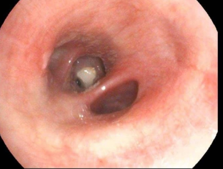 Львів'янка 8 місяців не могла позбутися кашлю: у жінки в легенях застряг зуб Львів'янка 8 місяців не могла позбутися кашлю: у жінки в легенях застряг зуб