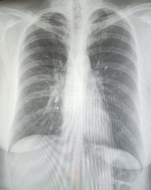 Львів'янка 8 місяців не могла позбутися кашлю: у жінки в легенях застряг зуб