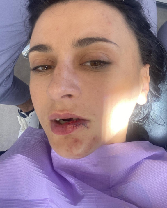 Вибиті зуби і розірвана губа: артистка з Чернівців Navka травмувалася на зйомці фільму