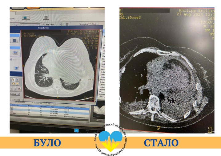 З серця відкачали літр рідини: у Чернівцях лікарі врятували життя пацієнтки