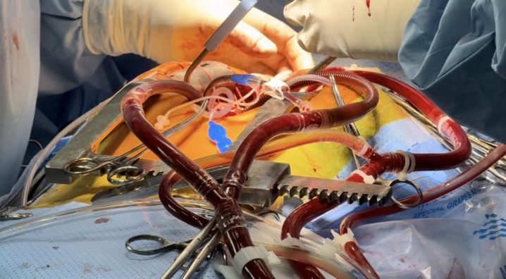 Зупиняли серця: хірурги у Чернівцях виконали дві складні операції на власному обладнанні Зупиняли серця: хірурги у Чернівцях виконали дві складні операції на власному обладнанні