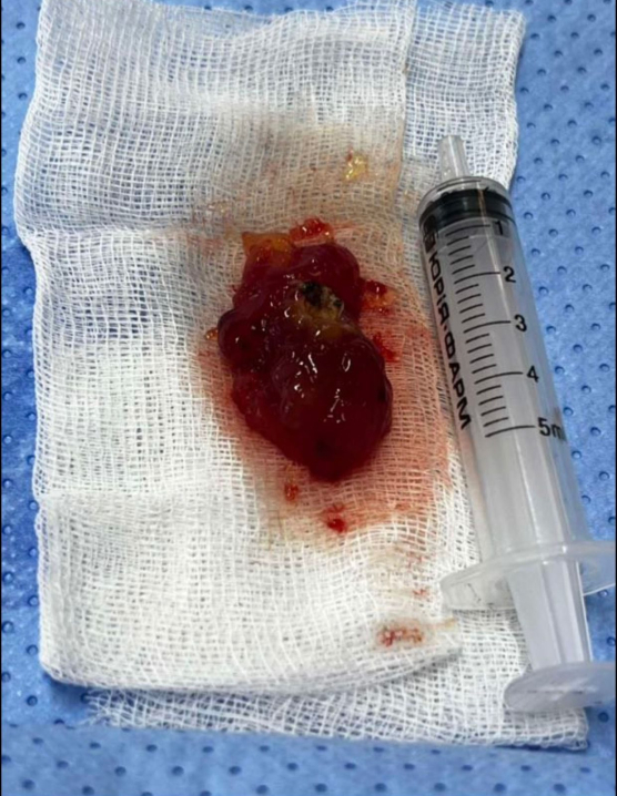 Чернівецькі хірурги успішно прооперували жінку з пухлиною серця Чернівецькі хірурги успішно прооперували жінку з пухлиною серця