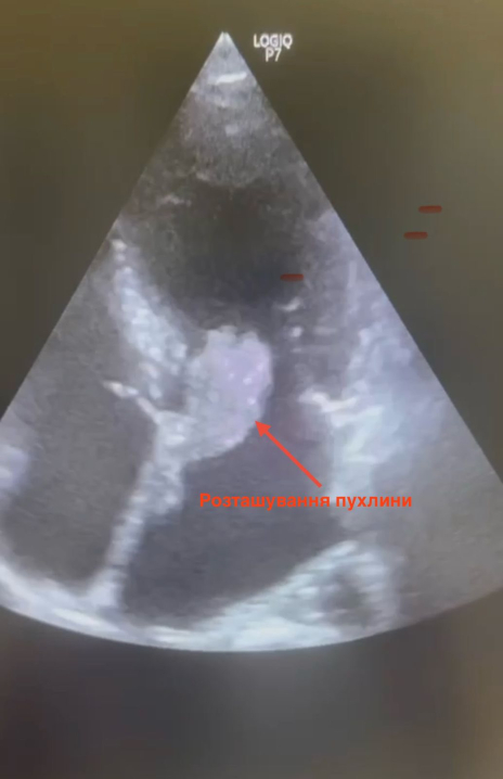 Чернівецькі хірурги успішно прооперували жінку з пухлиною серця Чернівецькі хірурги успішно прооперували жінку з пухлиною серця