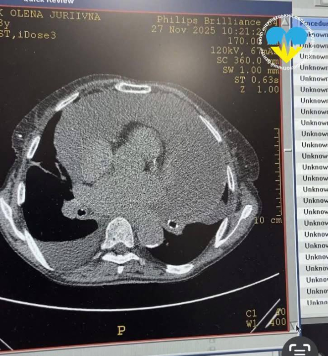 Скаржилася на сильну задуху. У Чернівцях медики викачали 2,5 л рідини з серця пенсіорнерки