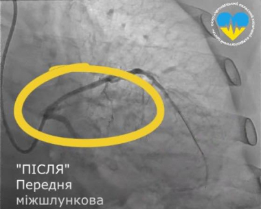 У Чернівцях кардіохірурги виконали унікальну операцію на серці