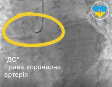 У Чернівцях кардіохірурги виконали унікальну операцію на серці