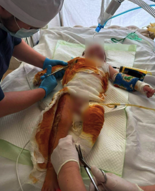 У Чернівцях лікарі врятували дитину з тяжкими опіками, яку доправили у критичному стані